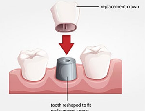 Dental Crown pain