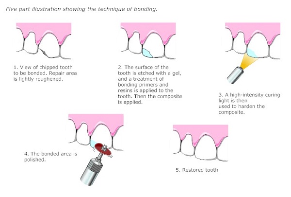 What is Dental Bonding?  Steps, Uses & Benefits Explained