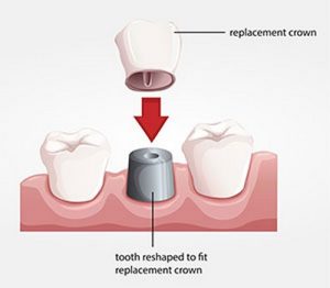 Effective Ways to Deal with Pain in Temporary Dental Crowns