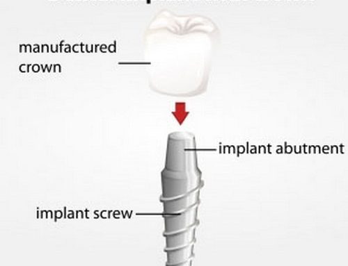 Dental Implants Vs. Dental Bridges – how to choose